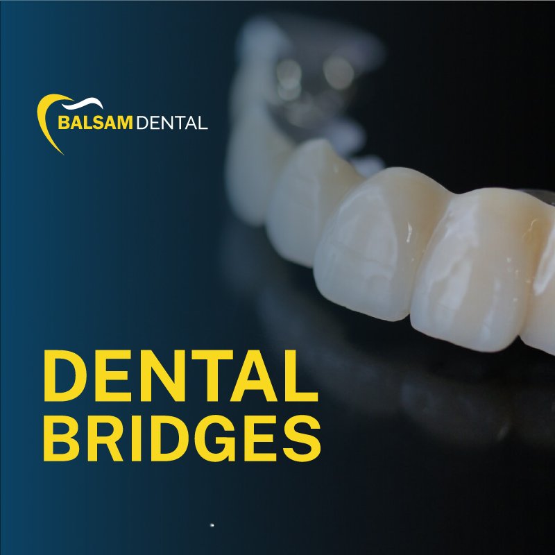 dental bridges